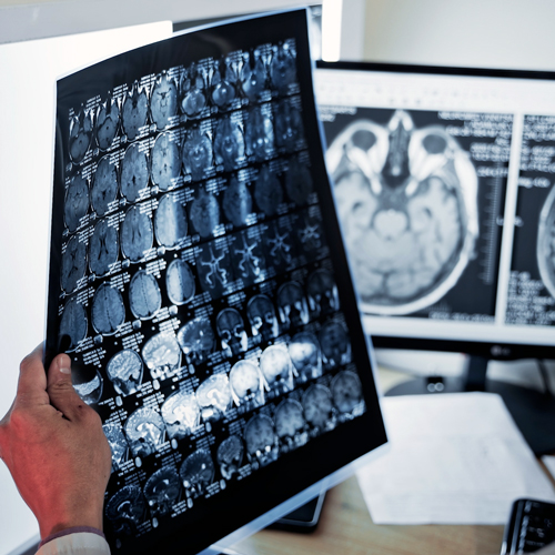 a hand holds a negative with brain scan images